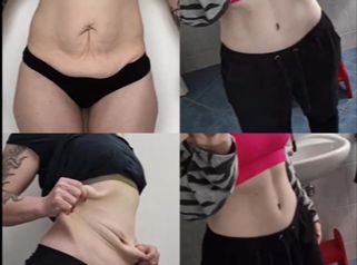 Abdominoplastika