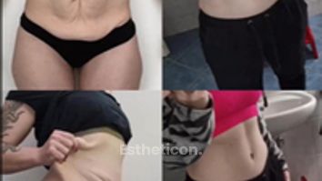 Abdominoplastika