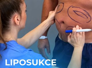 Liposukce břicha