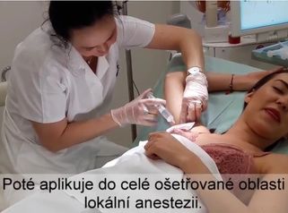 Trvalé odstranění pocení