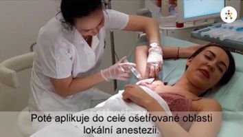 Trvalé odstranění pocení