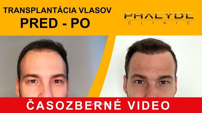 Transplantace vlasů pred po: Matúš (Časozberné video) - PHAEYDE Clinic