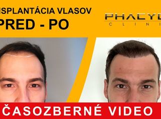 Transplantace vlasů pred po: Matúš (Časozberné video) - PHAEYDE Clinic