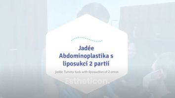 Jadée - Tummy tuck with liposuction of 2 areas