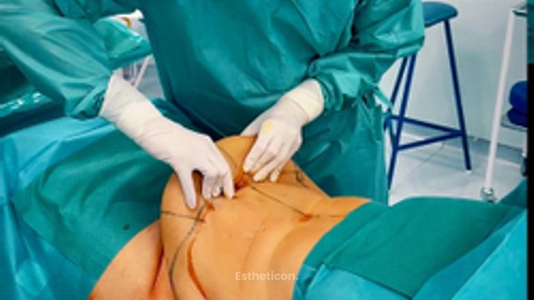krásná proměna po abdominoplastice s liposukcí boků od našeho MUDr. Menouška
