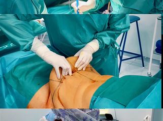 krásná proměna po abdominoplastice s liposukcí boků od našeho MUDr. Menouška