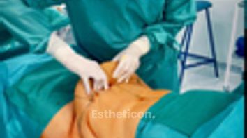 krásná proměna po abdominoplastice s liposukcí boků od našeho MUDr. Menouška