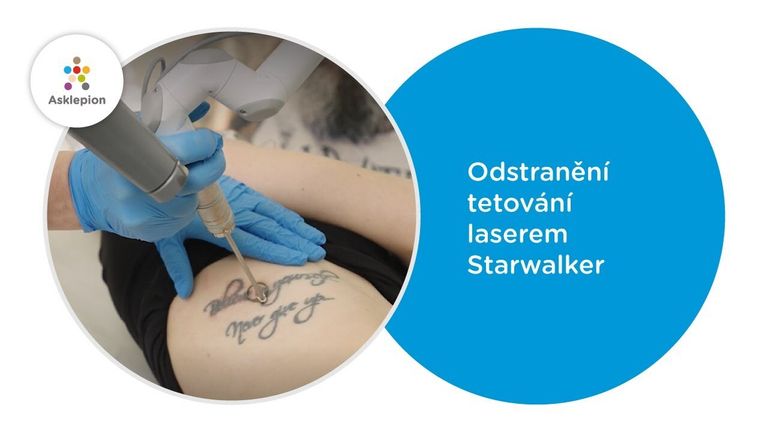 Odstranění tetování laserem Starwalker - Petra Weber