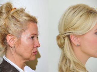 Plastická operace obličeje - Facelift a YES Lifting