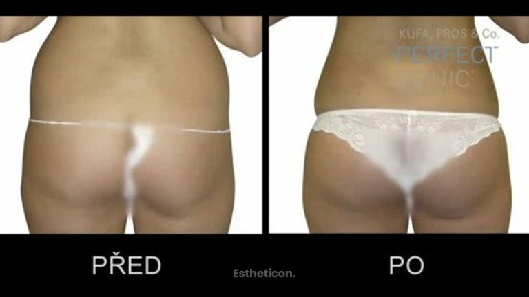 Ambulantní tumescentní liposukce - MUDr. Lukáš Frajer