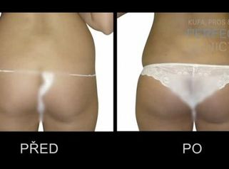 Ambulantní tumescentní liposukce - MUDr. Lukáš Frajer