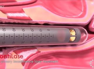 Léčba inkontinence v Laser Centrum Flora