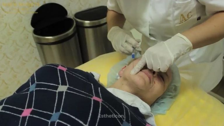 Aplikace hyaluronové kyseliny - plastická a estetická medicína AURUM AESTHETIC CLINIC