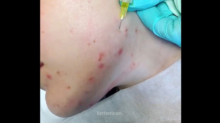 Léčba akné - FORMOSITAS - Klinika estetické medicíny, s.r.o.