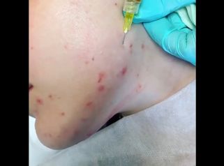Léčba akné - FORMOSITAS - Klinika estetické medicíny, s.r.o.