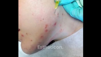 Léčba akné - FORMOSITAS - Klinika estetické medicíny, s.r.o.