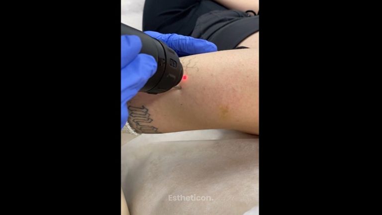 Odstranění tetování - Laserová Dermatologická Klinika ALTOS