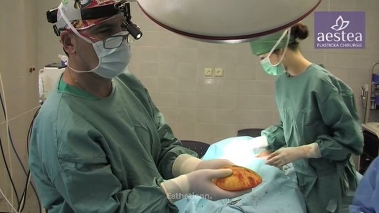 Augmentace MPS implantáty