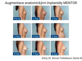 Proč je pevnější gel v anatomických implantátech žádoucí?