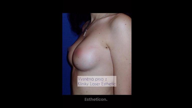 Zvětšení prsou - Klinika Laser Esthetic