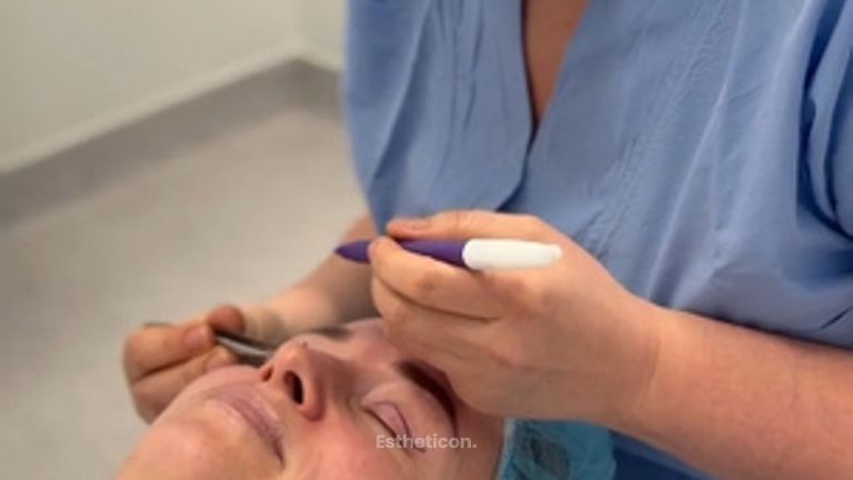 MBC - Víčka - průběh