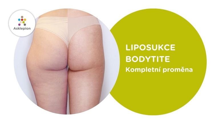 Liposukce BodyTite v Asklepionu – Kompletní proměna