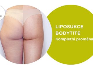 Liposukce BodyTite v Asklepionu – Kompletní proměna