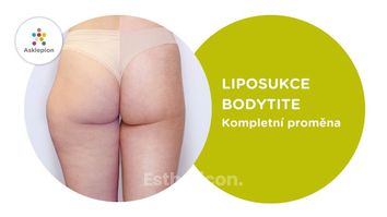 Liposukce BodyTite v Asklepionu – Kompletní proměna