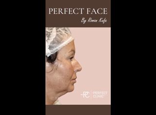 Facelift - Perfect Clinic - centrum estetické medicíny