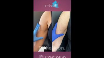 Endolift - FORMOSITAS - Klinika estetické medicíny, s.r.o.