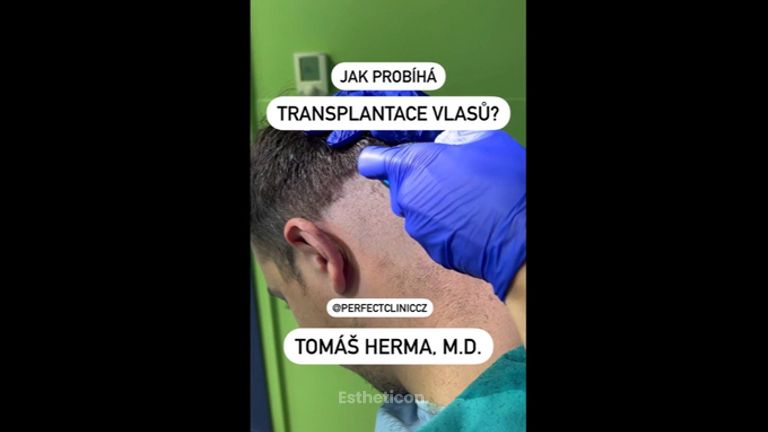 Transplantace vlasů - Perfect Clinic - centrum estetické medicíny
