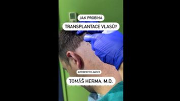 Transplantace vlasů - Perfect Clinic - centrum estetické medicíny