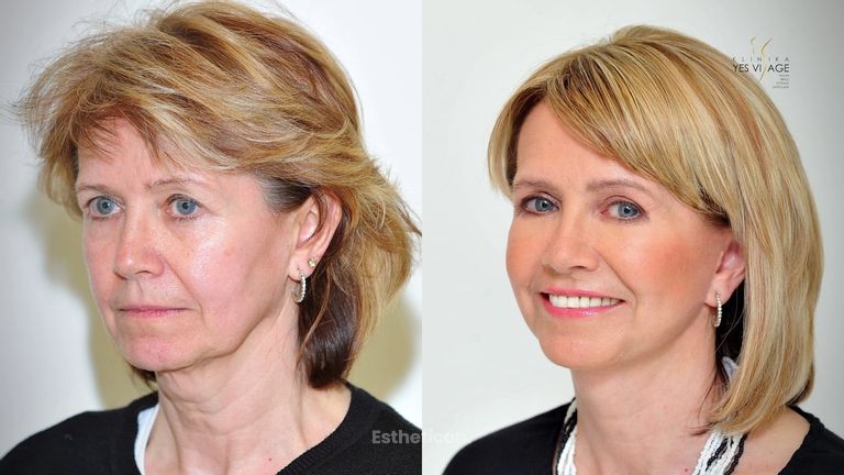 PROMĚNA: Plastická operace obličeje - Facelift a víčka - paní Zdena na Klinice YES VISAGE