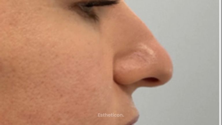 Nechirurgická korekce nosu