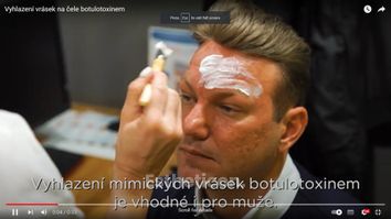 Vyhlazení vrásek na čele botulotoxinem