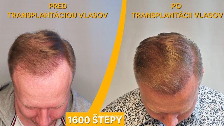 PHAEYDE Clinic - Transplantace vlasů