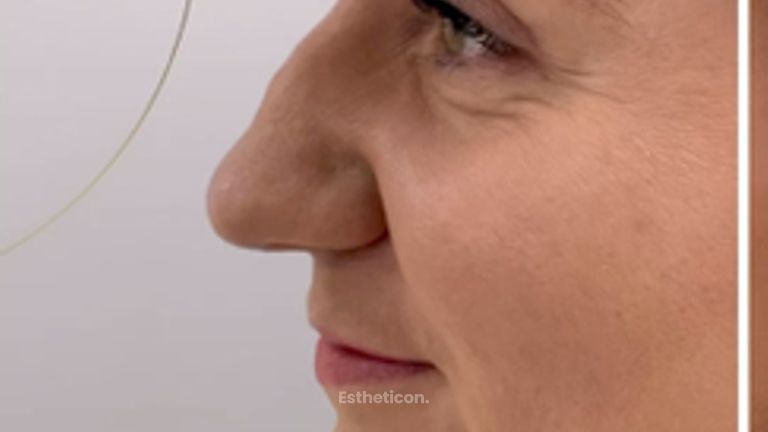 Nechirurgická korekce nosu