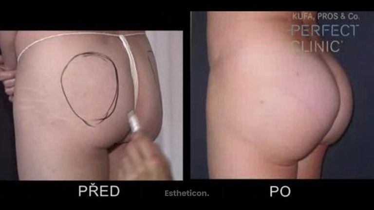 Zvětšení a modelace hýždí implantátem - MUDr. Roman Kufa