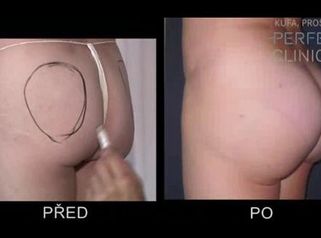 Zvětšení a modelace hýždí implantátem - MUDr. Roman Kufa