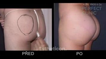 Zvětšení a modelace hýždí implantátem - MUDr. Roman Kufa