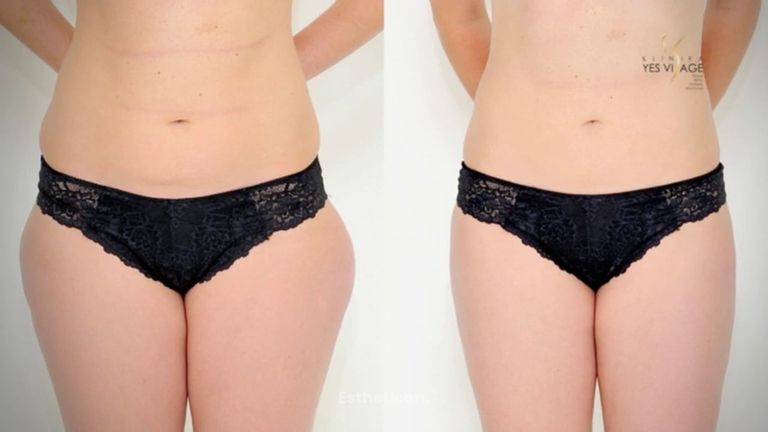 Lipotransfer - Přenos tuku na Klinice YES VISAGE