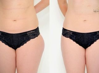 Lipotransfer - Přenos tuku na Klinice YES VISAGE
