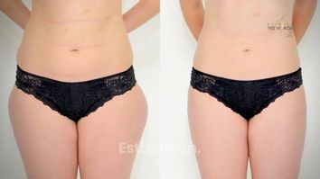 Lipotransfer - Přenos tuku na Klinice YES VISAGE