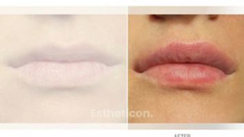 Lip augmentation